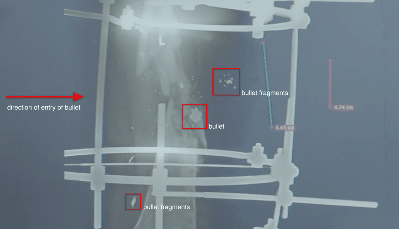 X-ray – fragments - This x-ray of the same patient displays the complete shattering of the patient’s tibia, in the lower leg, likely the result of a high velocity round. It shows the remaining bulk of the bullet, as well as smaller bullet fragments which remained in the body of the patient. (Forensic Architecture/Shifa Hospital)