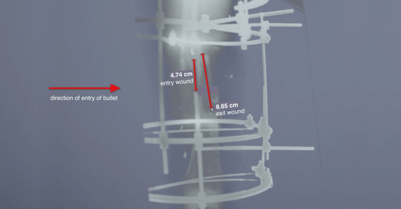 X-ray – exit wounds - The difference between the size of the entry and exit wounds, as seen in this x-ray, is indicative of high-velocity ammunition, according to the UN Commission report (p163, paragraphs 552-554). (Forensic Architecture/Shifa Hospital)