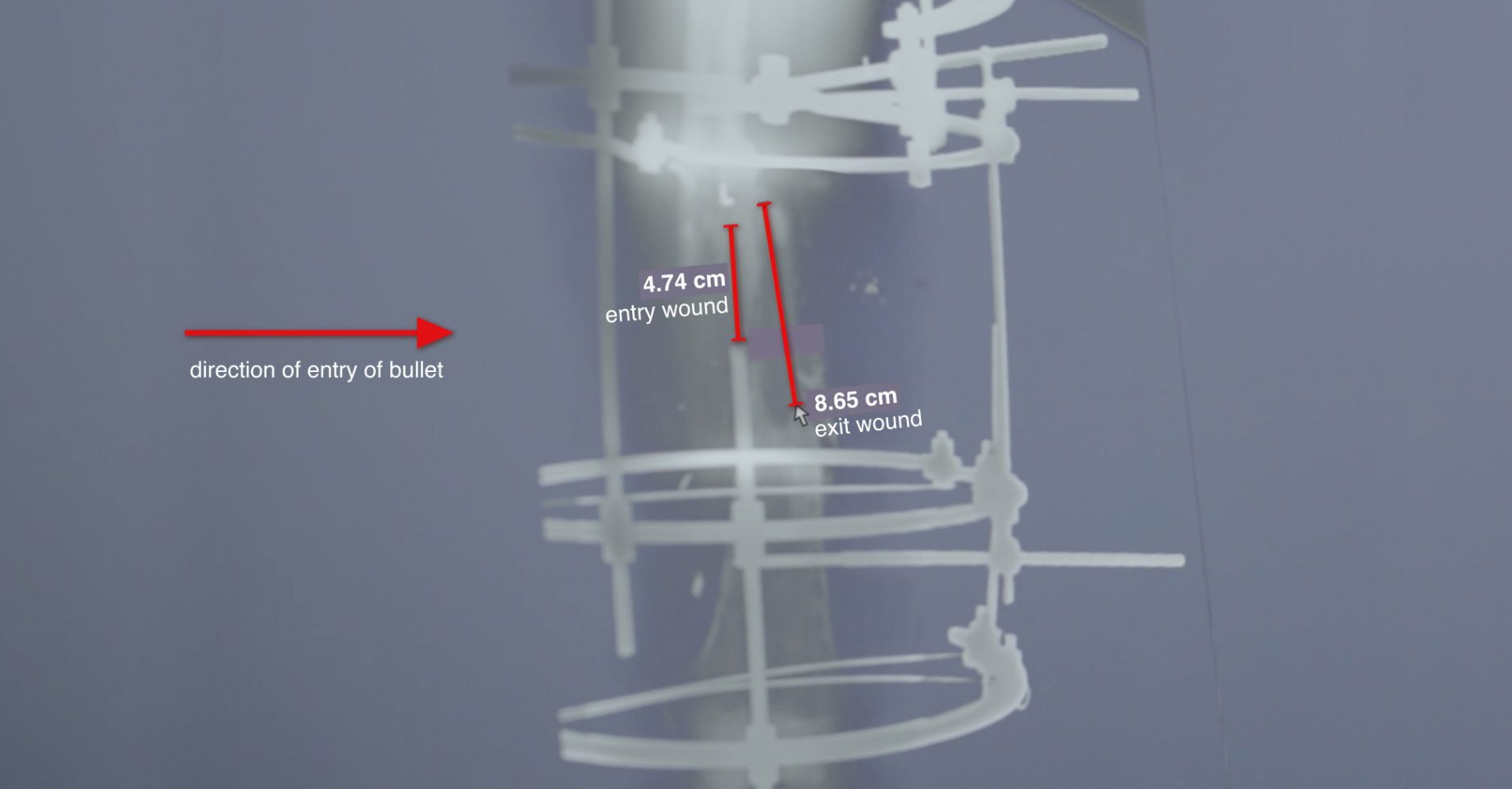 X-ray – exit wounds - The difference between the size of the entry and exit wounds, as seen in this x-ray, is indicative of high-velocity ammunition, according to the UN Commission report (p163, paragraphs 552-554). (Forensic Architecture/Shifa Hospital)